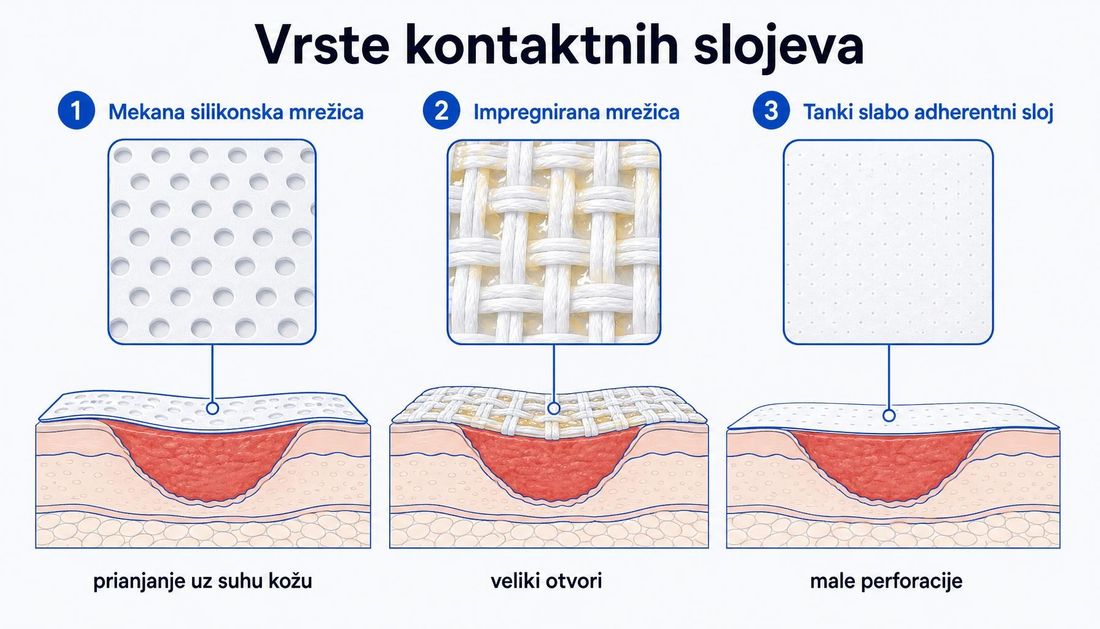 Usporedni prikaz triju vrsta kontaktnih slojeva: meke silikonske mrežice, impregnirane mrežice i tankoga slabo adherentnog sloja, s vidljivom razlikom u veličini otvora i strukturi materijala.