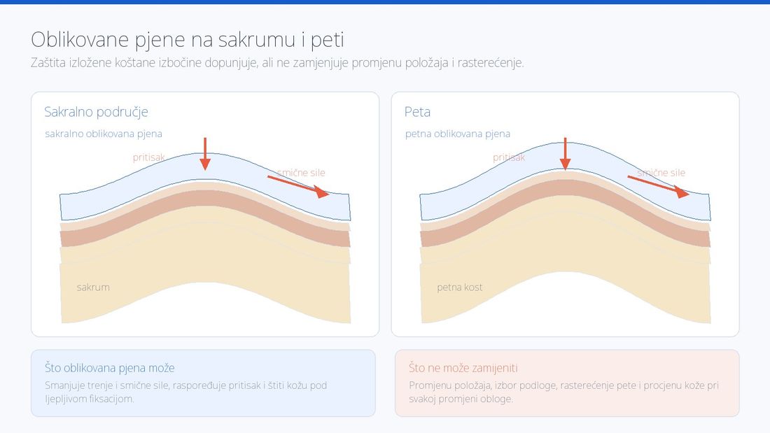 Prikaz oblikovane obloge na peti i na sjedalnom području