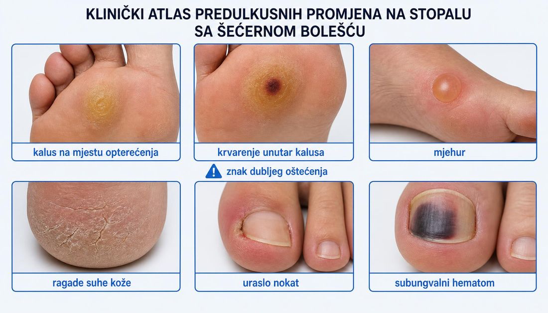 Šest polja s predulkusnim promjenama na stopalu: kalus na mjestu opterećenja, krvarenje unutar kalusa označeno kao znak dubljeg oštećenja, mjehur, ragade suhe kože, uraslo nokat i subungvalni hematom.