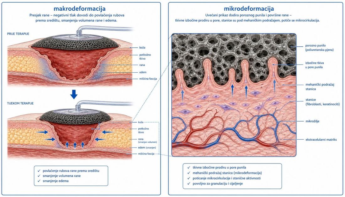 Shema u dva panela koja prikazuje makrodeformaciju rane i mikrodeformaciju na dodiru poroznog punila i površine rane.
