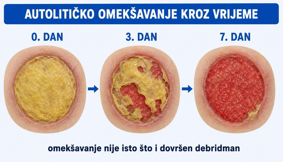Tri prikaza iste rane odozgo kroz sedam dana: prvo ležište prekriveno suhim žutim fibrinom, zatim djelomično omekšan fibrin s vidljivom granulacijom i na kraju pretežno granulacijsko tkivo.