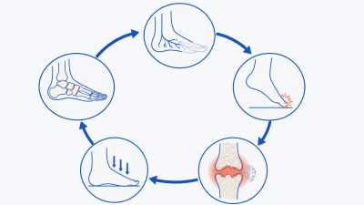 Kružna shema u pet koraka: periferna neuropatija smanjuje zaštitni osjet, nezapažena trauma ili ponavljano opterećenje pokreće upalu, upala razgrađuje kost i oslabljuje ligamente, hodanje se nastavlja jer bol nedostaje, a posljedica je subluksacija i kolaps stopala koji dodatno pojačava upalu.