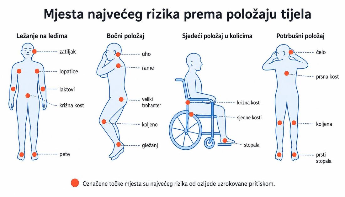 Shema četiriju položaja tijela s označenim mjestima najvećeg rizika: pri ležanju na leđima zatiljak, lopatice, laktovi, križna kost i pete; u bočnom položaju uho, rame, veliki trohanter, koljeno i gležanj; u sjedećem položaju u kolicima križna kost, sjedne kosti i stopala; u potrbušnom položaju čelo, prsna kost, koljena i prsti stopala.