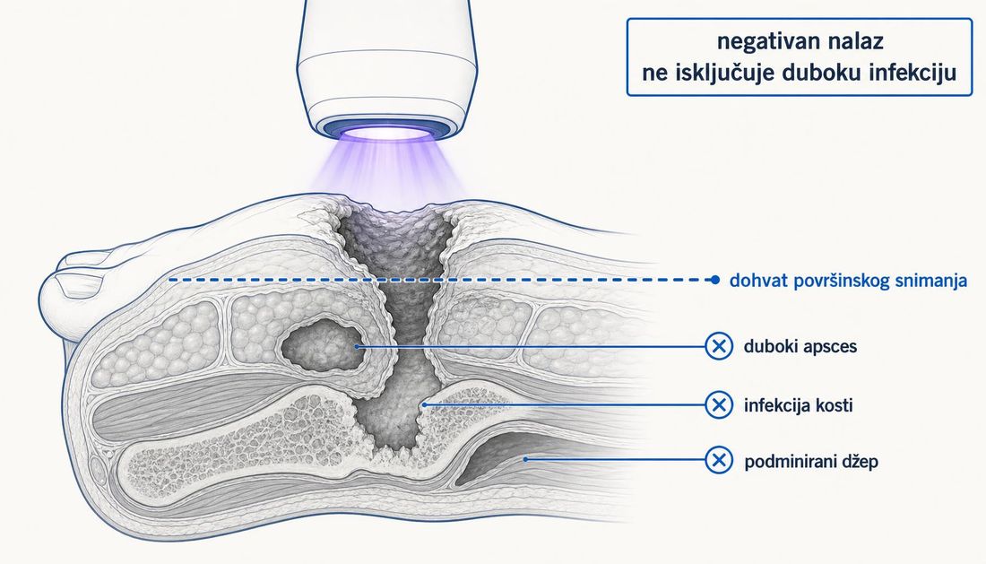 Presjek stopala s dubokom ranom i uređajem koji emitira violetno svjetlo; iscrtkana linija označava dohvat površinskog snimanja, a duboki apsces, infekcija kosti i podminirani džep ostaju ispod te granice.
