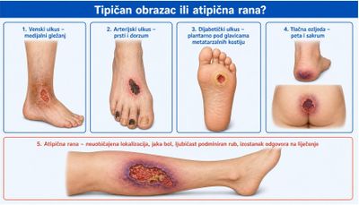 Shema u pet polja: venski ulkus na medijalnom gležnju, arterijski ulkus na prstima i dorzumu stopala, dijabetički ulkus plantarno pod glavicama metatarzalnih kostiju, tlačna ozljeda pete i sakruma te atipična rana na lateralnoj strani potkoljenice s ljubičastim podminiranim rubom.