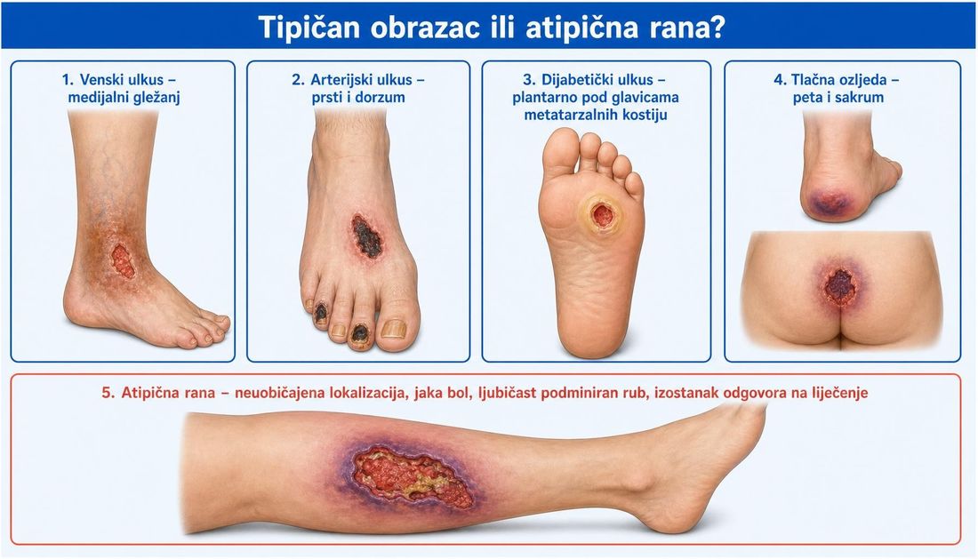 Shema u pet polja: venski ulkus na medijalnom gležnju, arterijski ulkus na prstima i dorzumu stopala, dijabetički ulkus plantarno pod glavicama metatarzalnih kostiju, tlačna ozljeda pete i sakruma te atipična rana na lateralnoj strani potkoljenice s ljubičastim podminiranim rubom.