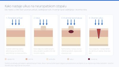 Četiri faze nastanka ulkusa na neuropatskom stopalu: ponavljani pritisak, kalus, krvarenje ispod kalusa i otvoreni ulkus, prikazani na presjeku kože.