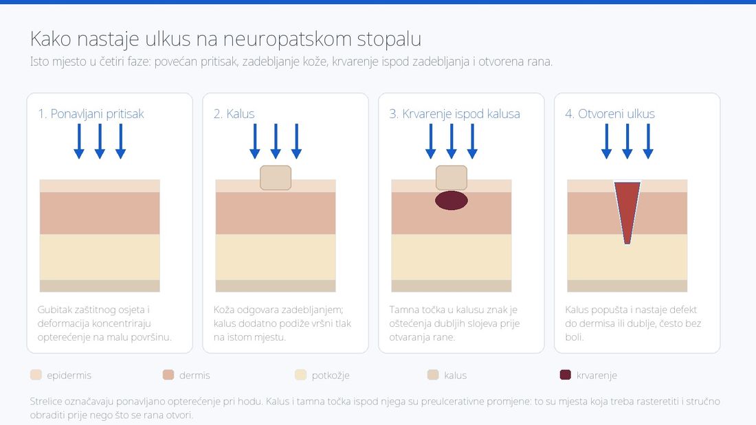 Četiri faze nastanka ulkusa na neuropatskom stopalu: ponavljani pritisak, kalus, krvarenje ispod kalusa i otvoreni ulkus, prikazani na presjeku kože.