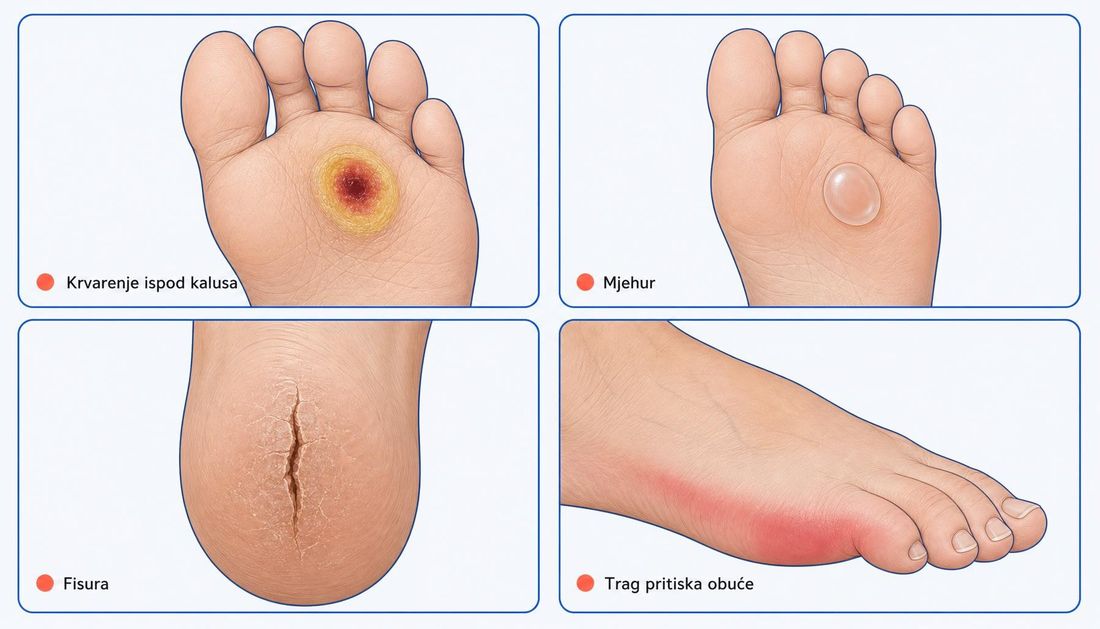Četiri prikaza neuropatskoga stopala s predulkusnim promjenama: debeli žuti kalus s tamnim krvarenjem u sebi, mjehur ispunjen bistrom tekućinom na prednjem dijelu tabana, duboka suha fisura na peti i crveni trag pritiska uz rub obuće s lokalnom oteklinom.