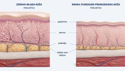 Usporedni anatomski presjek zdrave mlađe kože i krhke starenjem promijenjene kože podlaktice, s označenim epidermisom, dermisom, potkožjem i oslabljenom vezom slojeva.