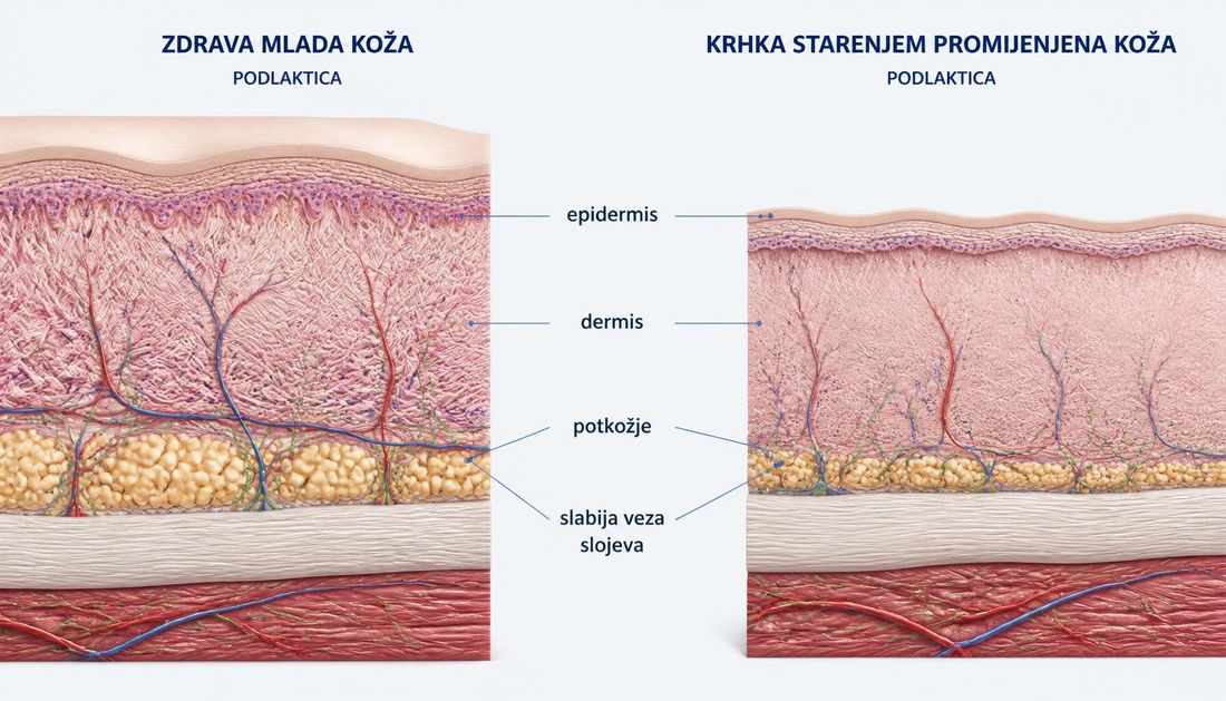Usporedni anatomski presjek zdrave mlađe kože i krhke starenjem promijenjene kože podlaktice, s označenim epidermisom, dermisom, potkožjem i oslabljenom vezom slojeva.