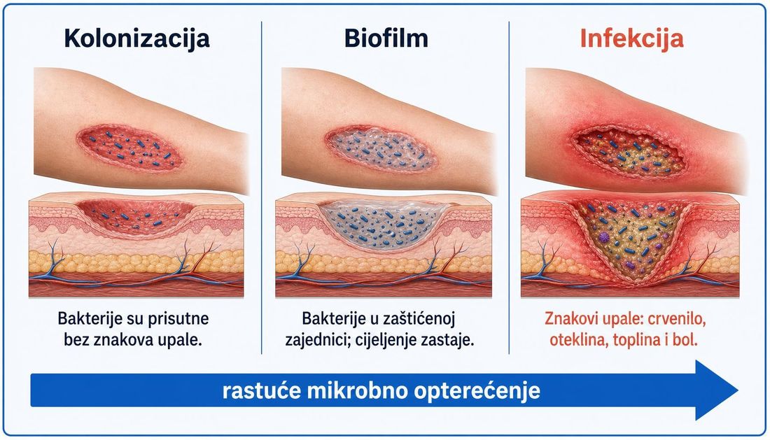 Shema u tri stupca s hrvatskim oznakama kolonizacija, biofilm i infekcija, s presjecima kože potkoljenice i strelicom rastućeg mikrobnog opterećenja.
