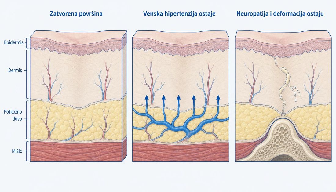 Tri anatomska presjeka kože nad istim zacijeljenim mjestom: lijevo zatvorena površina prekrivena tankim novim epitelom, u sredini ispod zatvorene površine proširene vene s povišenim tlakom u potkožju, desno blijedo propalo živčano vlakno i koštana deformacija koja iznutra pritišće taban.