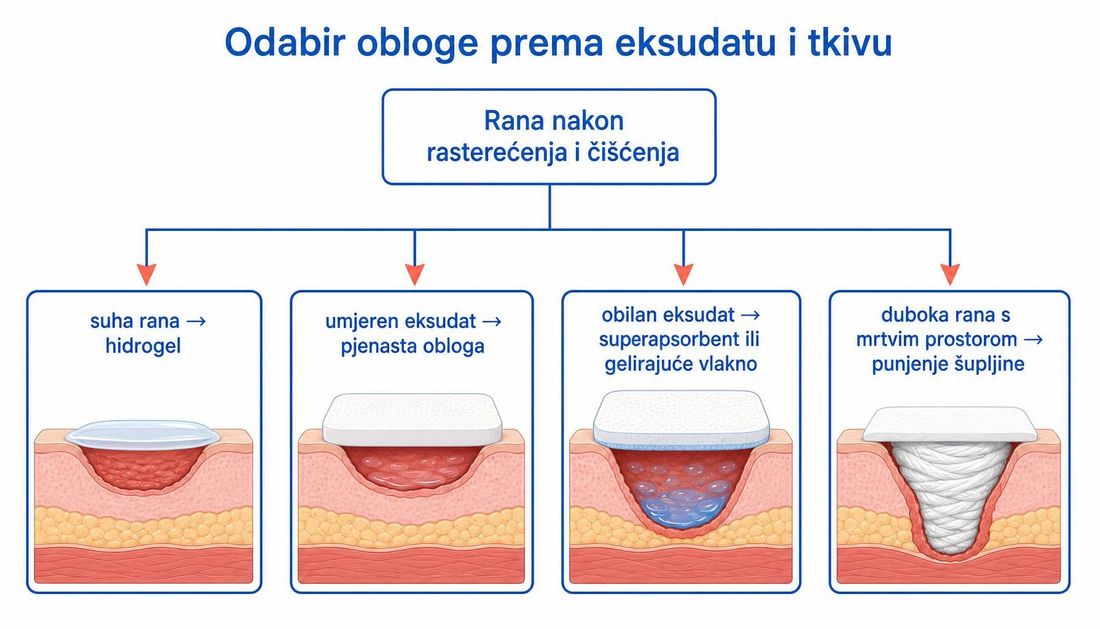 Shema odabira obloge nakon rasterećenja i čišćenja rane: suha rana i hidrogel, umjeren eksudat i pjenasta obloga, obilan eksudat i superapsorbent ili gelirajuće vlakno te duboka rana s mrtvim prostorom i punjenje šupljine.