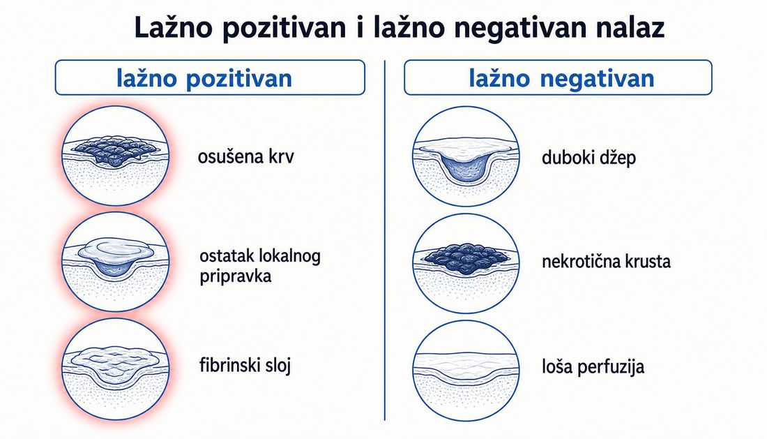Usporedni prikaz lažno pozitivnih nalaza (osušena krv, ostatak lokalnog pripravka, fibrinski sloj) i lažno negativnih nalaza (duboki džep, nekrotična krusta, loša perfuzija) u fluorescencijskom snimanju rane.