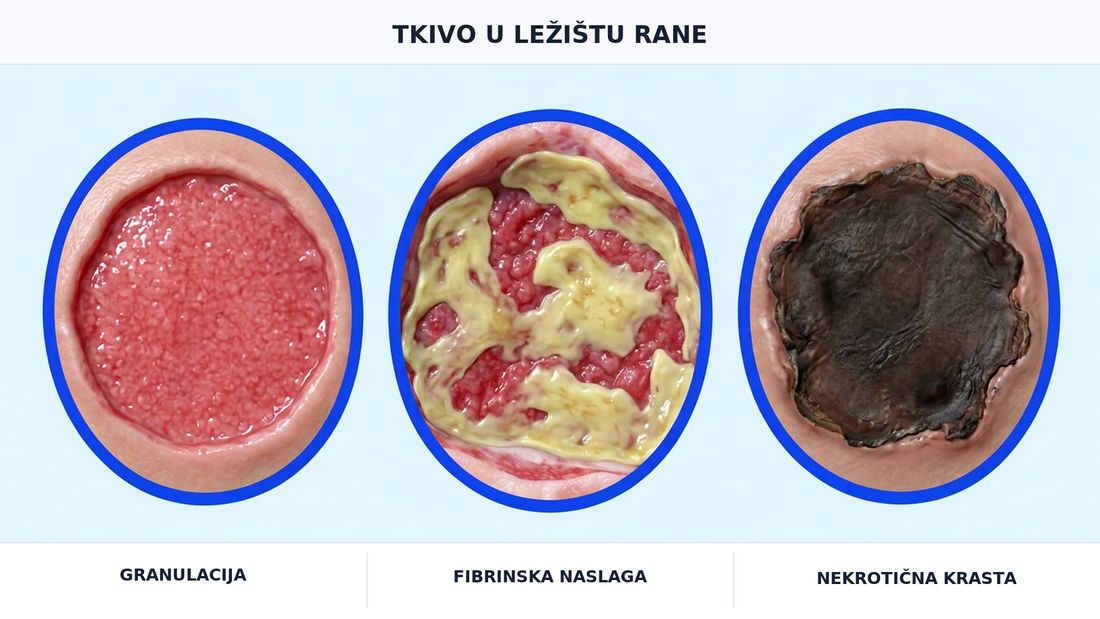 Tri povećala ležišta rane: zdrava crvena granulacija, žućkasti fibrinski naslagani sloj preko crvene podloge i tamna nekrotična stružina.