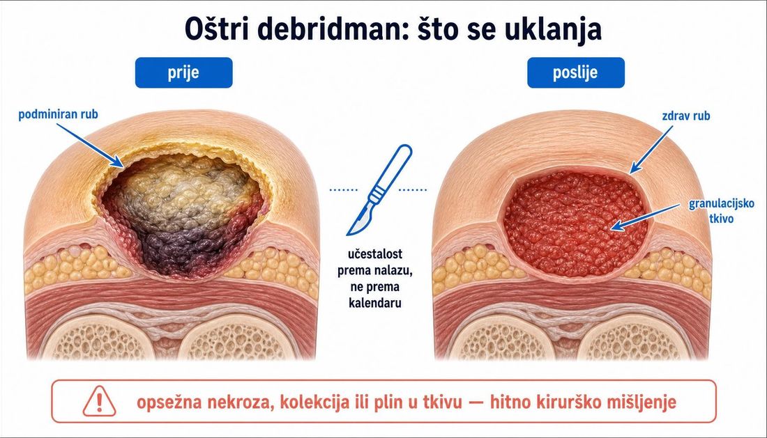 Usporedni presjek plantarnoga ulkusa prije i poslije oštroga debridmana: prije s zadebljanim kalusnim rubom, fibrinskim naslagama, nekrozom i podminiranim rubom, poslije s čistim granulacijskim ležištem i urednim rubom, uz napomenu da se učestalost određuje prema nalazu i da opsežna nekroza, kolekcija ili plin u tkivu zahtijevaju hitno kirurško mišljenje.