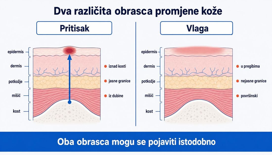Usporedni presjek kože: obrazac uzrokovan pritiskom iznad kosti s jasnim granicama i oštećenjem iz dubine te obrazac uzrokovan vlagom u pregibima s nejasnim granicama i površinskim oštećenjem, uz napomenu da se mogu pojaviti istodobno.