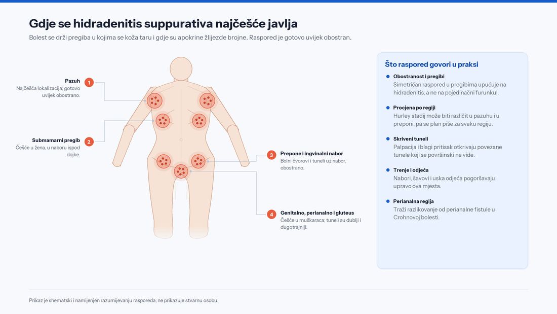 Shematski prikaz tijela s označenim tipičnim mjestima hidradenitisa suppurativa: pazusi, submamarni pregibi, prepone te genitalno, perianalno i glutealno područje, obostrano.