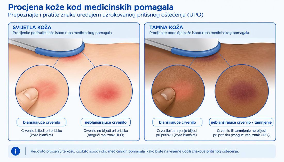 Shema rana prepoznavanja rane ozljede na svjetlijoj i tamnijem tenu kože: blanširajuće crvenilo, neblanširajuće tamnjenje, lokalizirana toplina i bol kao rani znakovi.