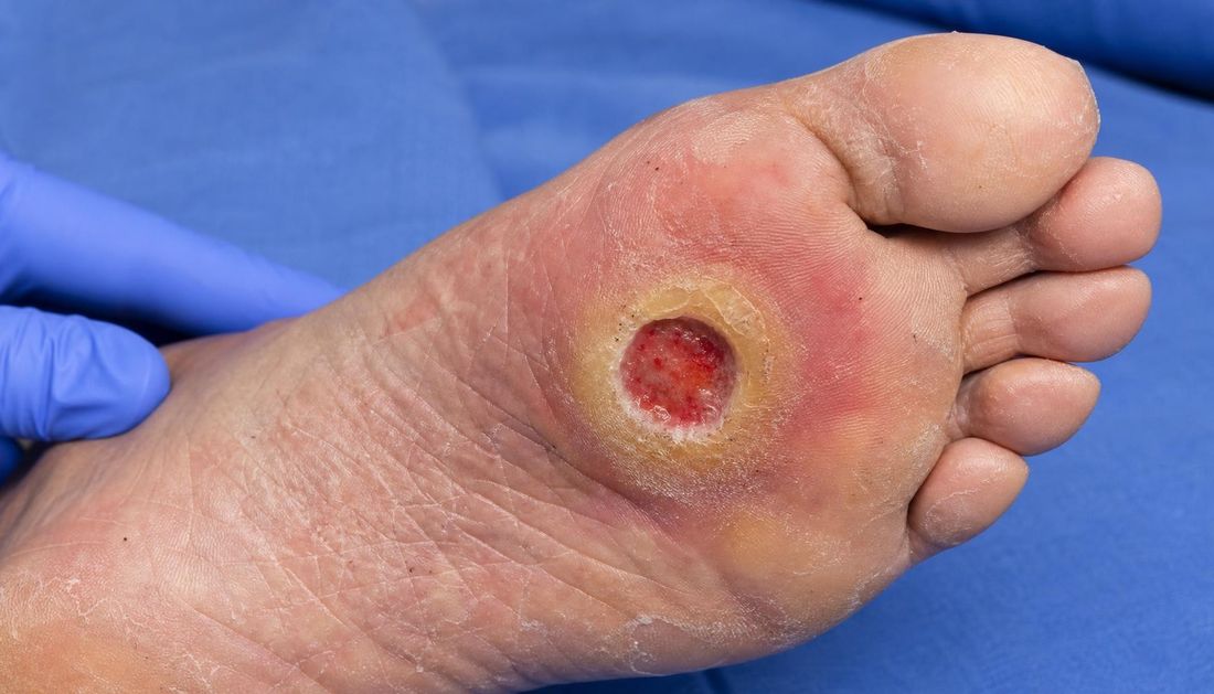 Fotorealističan atlasni prikaz tabana prednjeg dijela stopala s neuropatskim ulkusom ispod glave prve metatarzalne kosti, hiperkeratotskim rubom, granulacijskim dnom i umjerenim crvenilom okolne kože.