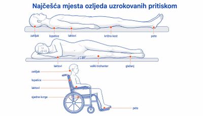 Shema najčešćih mjesta ozljeda uzrokovanih pritiskom u ležećem položaju na leđima, u bočnom položaju i pri sjedenju, s označenim zatiljkom, lopaticama, laktovima, križnom kosti, velikim trohanterom, gležnjem, sjednim kvrgama i petama.