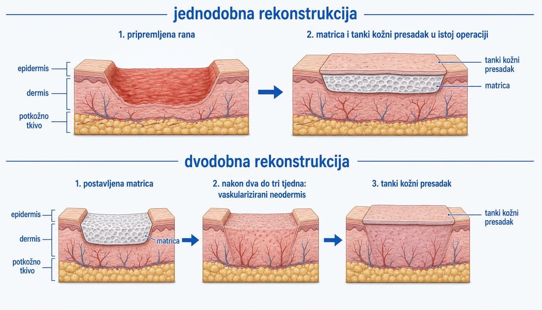 Shema jednodobne rekonstrukcije u kojoj se matrica i tanki kožni presadak postavljaju u istoj operaciji te dvodobne rekonstrukcije s matricom, vaskulariziranim neodermisom nakon dva do tri tjedna i naknadnim presatkom.