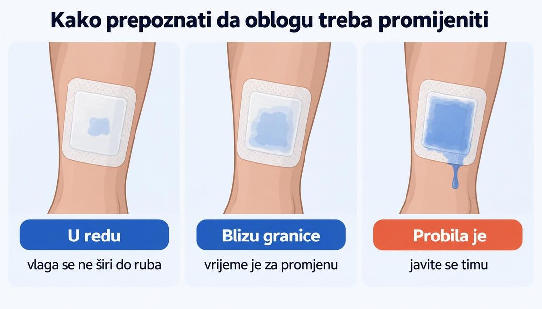 Tri prikaza obloge na potkoljenici: obloga u redu s malom vlažnom mrljom u sredini, obloga blizu granice s vlagom do ruba i obloga koja je probila s tekućinom na koži i uputom da se javite timu.