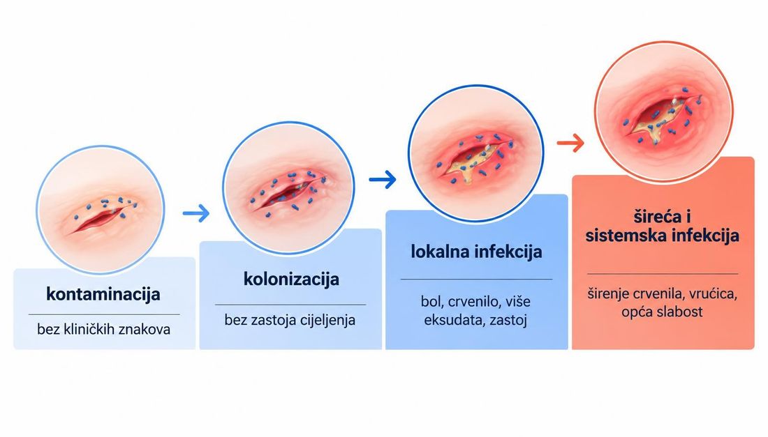 Shema kontinuuma infekcije rane u pet stupnjeva: kontaminacija, kolonizacija, lokalna infekcija, šireća infekcija i sistemska infekcija, s kratkim opisom nalaza i rastućom skalom hitnosti.